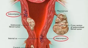 Adenomyozis Adenomyozis