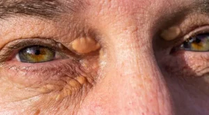 Ksantelezma (Göz kapağında yağ plağı) Ksantelezma (Göz kapağında yağ plağı)