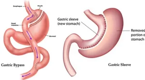 Tüp Mide Ameliyatı Nedir? Tüp Mide Ameliyatı Nedir?