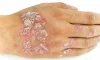 Sedef Hastalığı (Psoriasis) Nedir? Belirtileri, Nedenleri ve Tedavisi