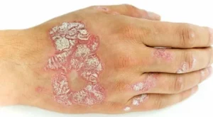 Sedef Hastalığı (Psoriasis) Nedir? Belirtileri, Nedenleri ve Tedavisi