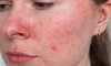 Rosacea Nedir? Belirtileri, Nedenleri ve Tedavi Yöntemleri