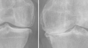 Diz Protezi Ameliyatı: Hastalar İçin Kapsamlı Bilgilendirme