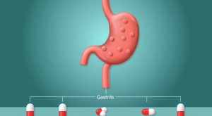 Gastrit ve Reflü Tedavisi: Hangi İlaçlar Kullanılmalı ve Nasıl Etkili Olur