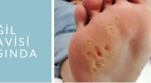 Siğil Nedir Tedavisi Nasıl Olur Siğil Nedir Tedavisi Nasıl Olur